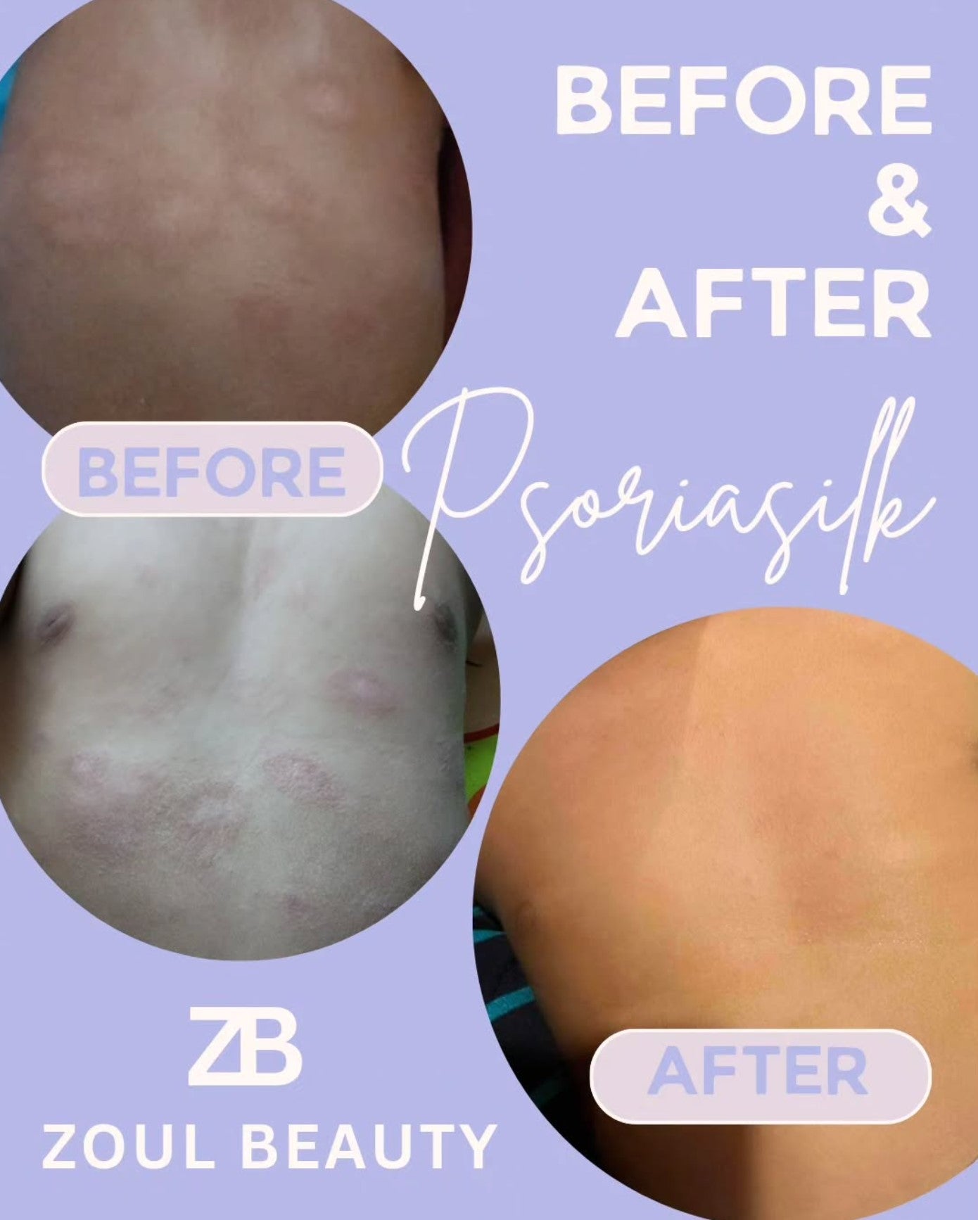 Psoriasilk